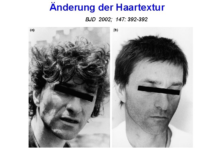 Änderung der Haartextur BJD 2002; 147: 392 -392 