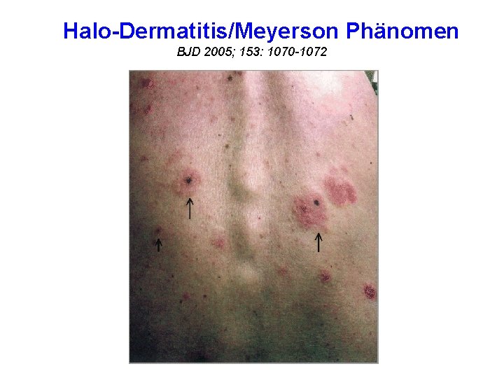 Halo-Dermatitis/Meyerson Phänomen BJD 2005; 153: 1070 -1072 