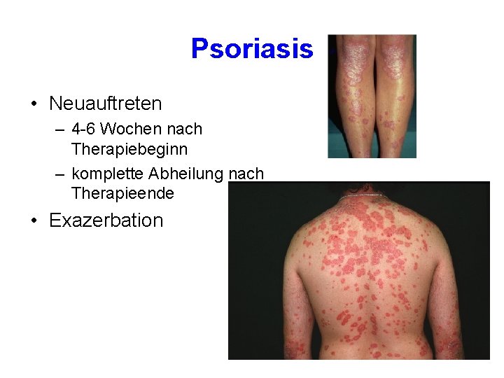 Psoriasis • Neuauftreten – 4 -6 Wochen nach Therapiebeginn – komplette Abheilung nach Therapieende