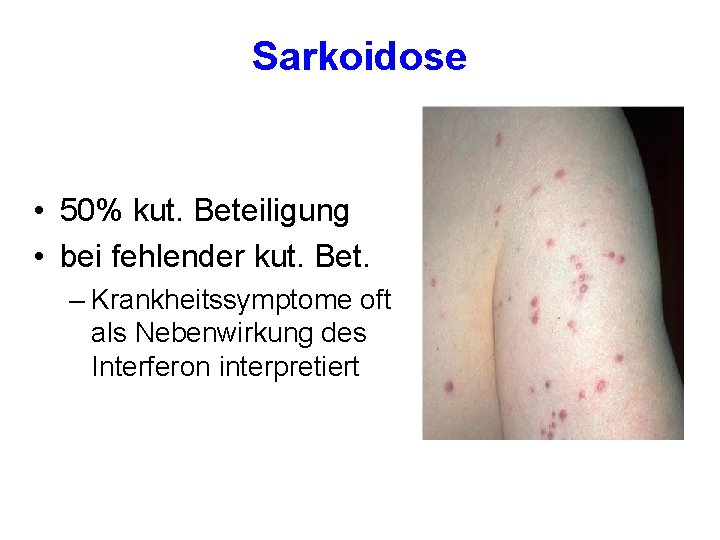 Sarkoidose • 50% kut. Beteiligung • bei fehlender kut. Bet. – Krankheitssymptome oft als