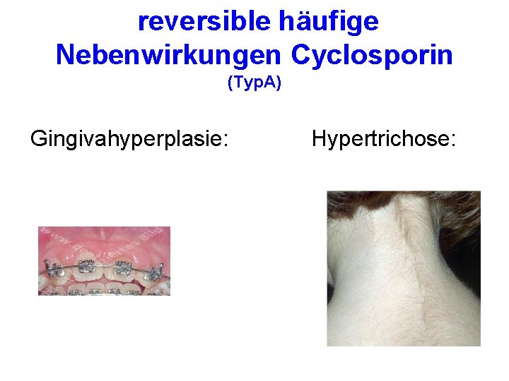 reversible häufige Nebenwirkungen Cyclosporin (Typ. A) Gingivahyperplasie: Hypertrichose: 