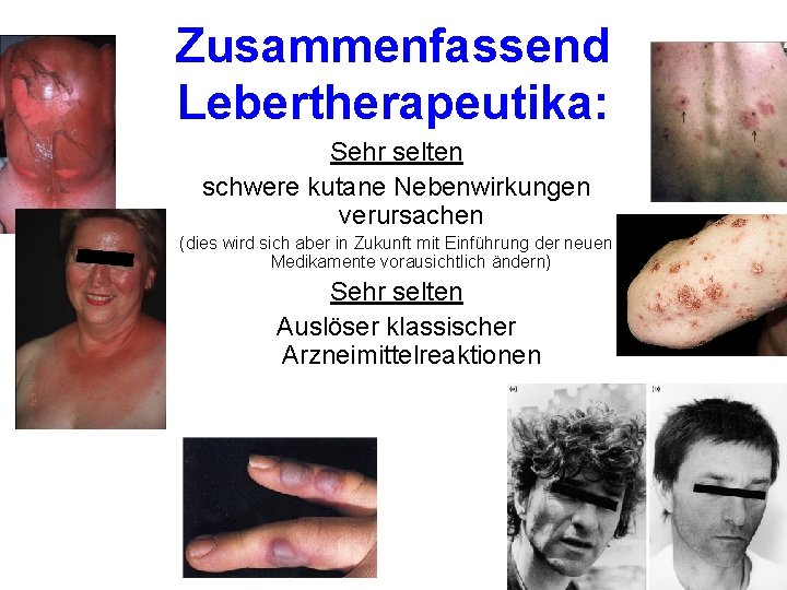 Zusammenfassend Lebertherapeutika: Sehr selten schwere kutane Nebenwirkungen verursachen (dies wird sich aber in Zukunft