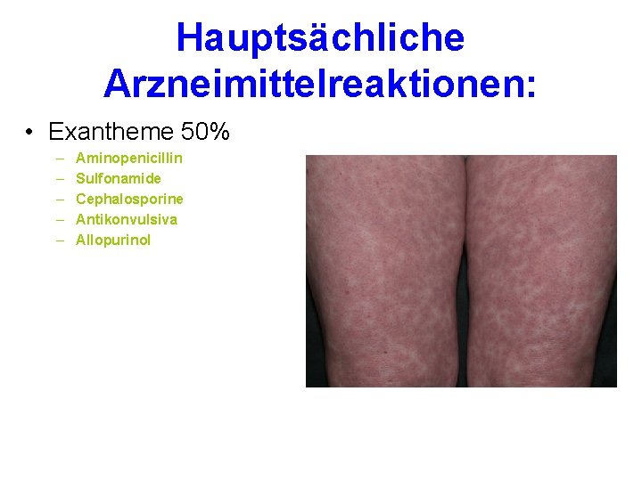 Hauptsächliche Arzneimittelreaktionen: • Exantheme 50% – – – Aminopenicillin Sulfonamide Cephalosporine Antikonvulsiva Allopurinol 