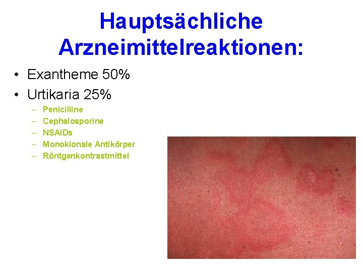 Hauptsächliche Arzneimittelreaktionen: • Exantheme 50% • Urtikaria 25% – – – Penicilline Cephalosporine NSAIDs