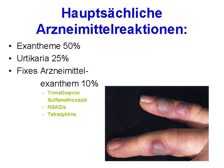 Hauptsächliche Arzneimittelreaktionen: • Exantheme 50% • Urtikaria 25% • Fixes Arzneimittelexanthem 10% – Trimethoprim