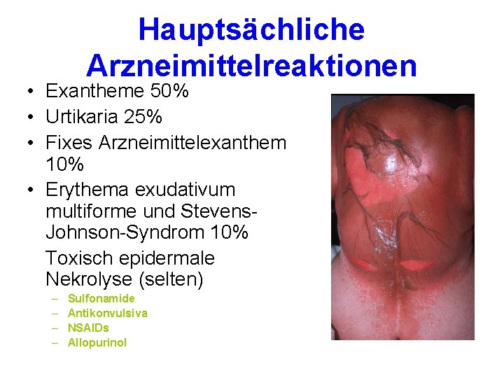 Hauptsächliche Arzneimittelreaktionen • Exantheme 50% • Urtikaria 25% • Fixes Arzneimittelexanthem 10% • Erythema