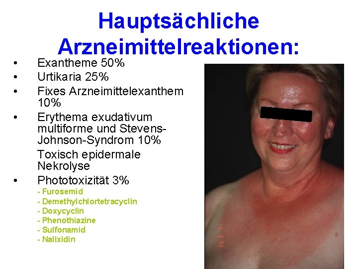  • • • Hauptsächliche Arzneimittelreaktionen: Exantheme 50% Urtikaria 25% Fixes Arzneimittelexanthem 10% Erythema