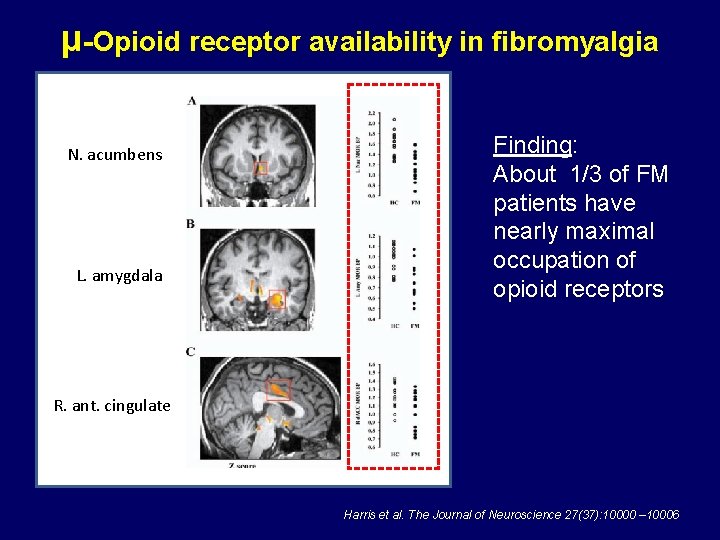 μ-Opioid receptor availability in fibromyalgia N. acumbens L. amygdala Finding: About 1/3 of FM