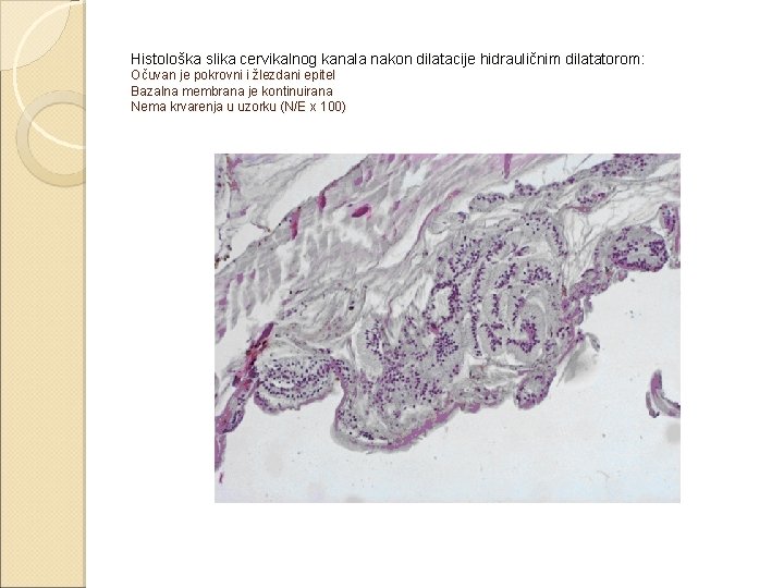 Histološka slika cervikalnog kanala nakon dilatacije hidrauličnim dilatatorom: Očuvan je pokrovni i žlezdani epitel