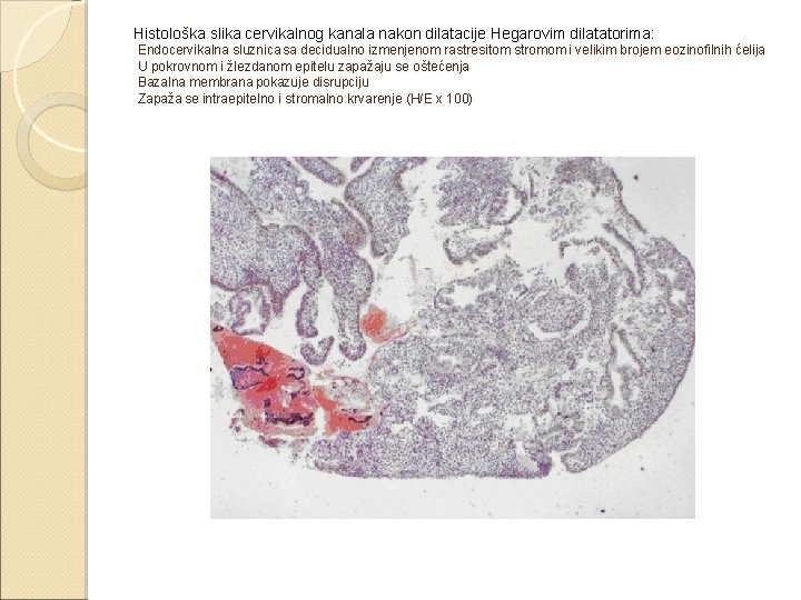 Histološka slika cervikalnog kanala nakon dilatacije Hegarovim dilatatorima: Endocervikalna sluznica sa decidualno izmenjenom rastresitom