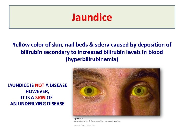 Jaundice Yellow color of skin, nail beds & sclera caused by deposition of bilirubin