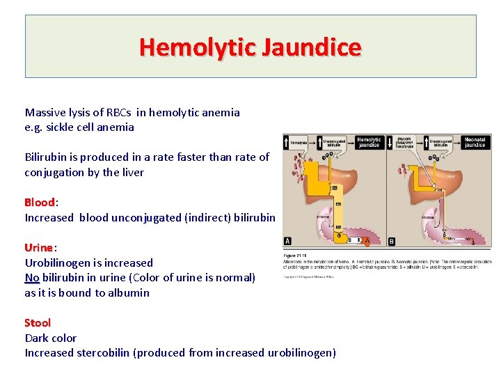 Hemolytic Jaundice Massive lysis of RBCs in hemolytic anemia e. g. sickle cell anemia
