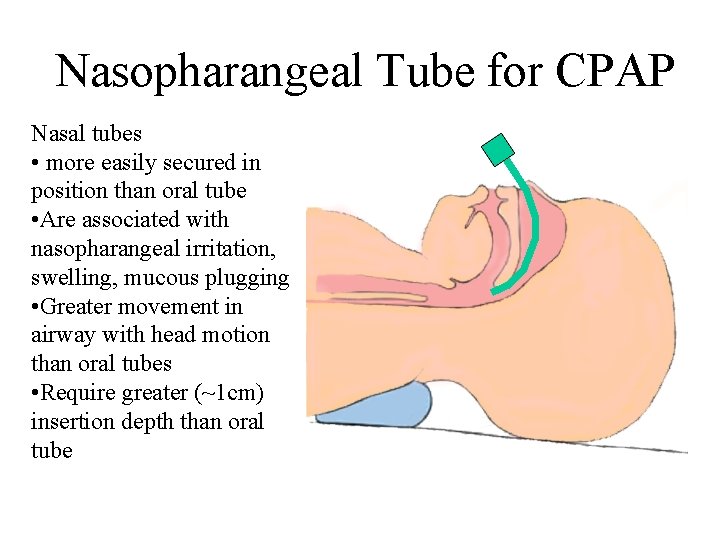 Nasopharangeal Tube for CPAP Nasal tubes • more easily secured in position than oral