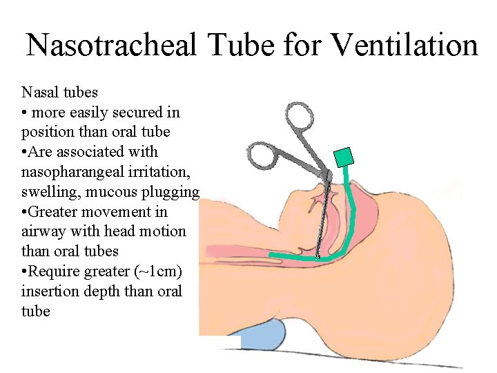Nasotracheal Tube for Ventilation Nasal tubes • more easily secured in position than oral