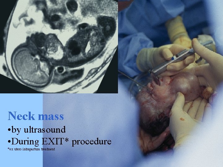 Neck mass • by ultrasound • During EXIT* procedure *ex utero intrapartum treatment 