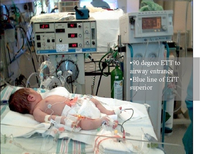  • 90 degree ETT to airway entrance • Blue line of ETT superior