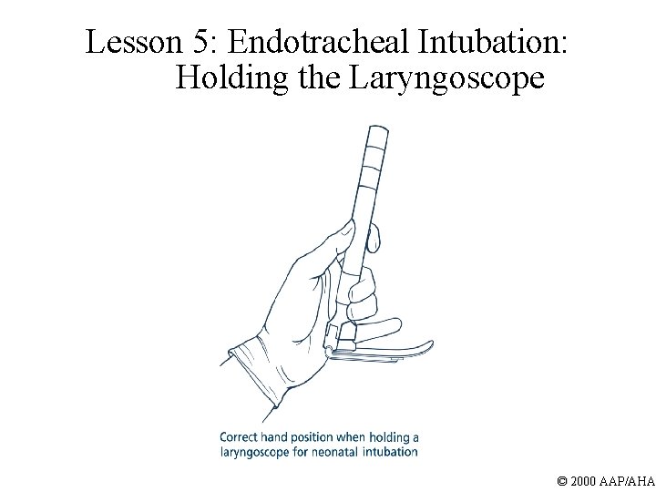 Lesson 5: Endotracheal Intubation: Holding the Laryngoscope © 2000 AAP/AHA 