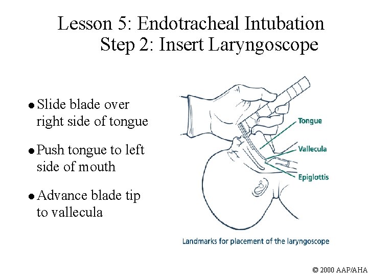 Lesson 5: Endotracheal Intubation Step 2: Insert Laryngoscope l Slide blade over right side
