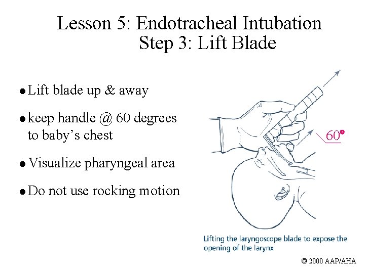 Lesson 5: Endotracheal Intubation Step 3: Lift Blade l Lift blade up & away