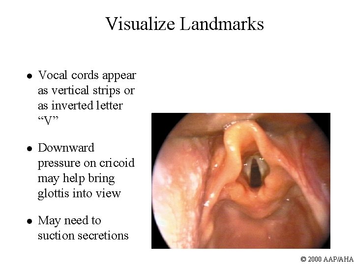 Visualize Landmarks l Vocal cords appear as vertical strips or as inverted letter “V”