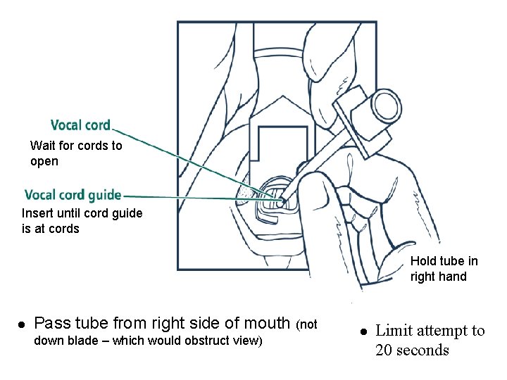 Wait for cords to open Insert until cord guide is at cords Hold tube
