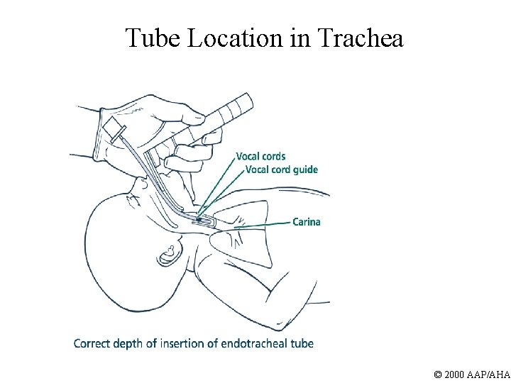 Tube Location in Trachea © 2000 AAP/AHA 