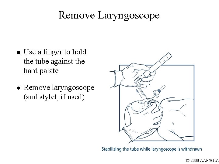 Remove Laryngoscope l Use a finger to hold the tube against the hard palate