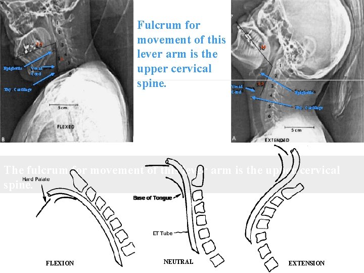 8. 3 5 Epiglottis Vocal Cord Thy. Cartilage Fulcrum for movement of this lever