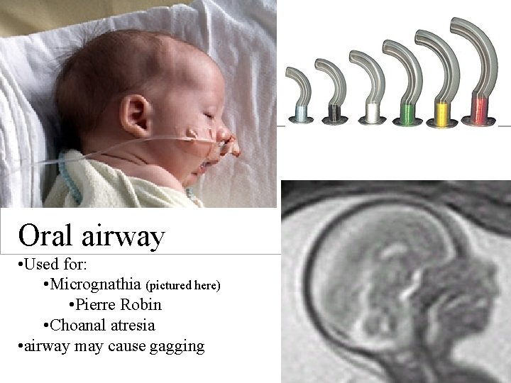  Oral airway • Used for: • Micrognathia (pictured here) • Pierre Robin •