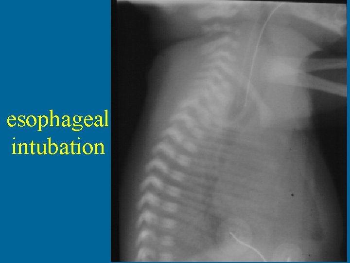 esophageal intubation 