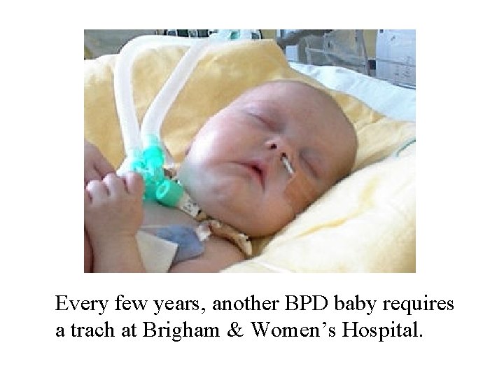 Every few years, another BPD baby requires a trach at Brigham & Women’s Hospital.