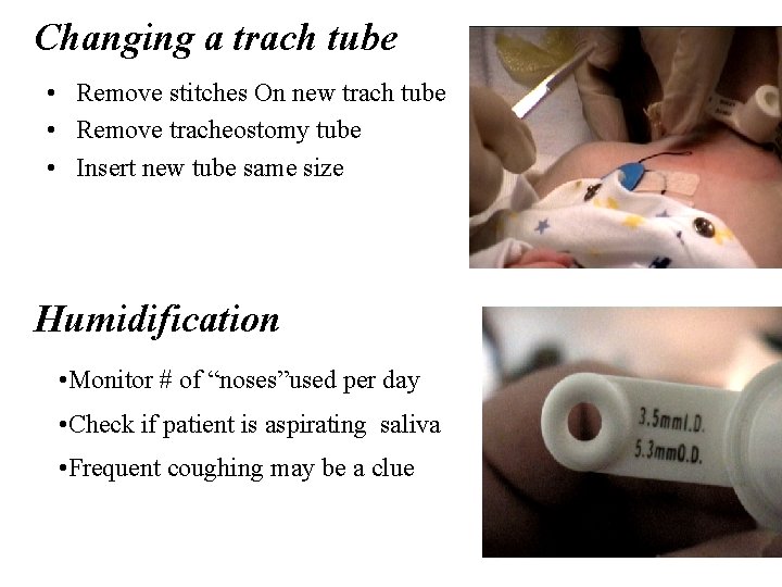Changing a trach tube • Remove stitches On new trach tube • Remove tracheostomy