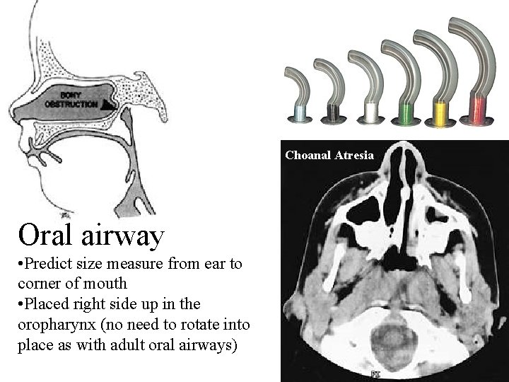Choanal Atresia Oral airway • Predict size measure from ear to corner of mouth
