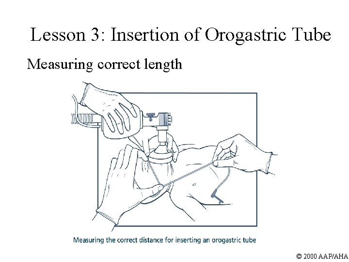 Lesson 3: Insertion of Orogastric Tube Measuring correct length © 2000 AAP/AHA 
