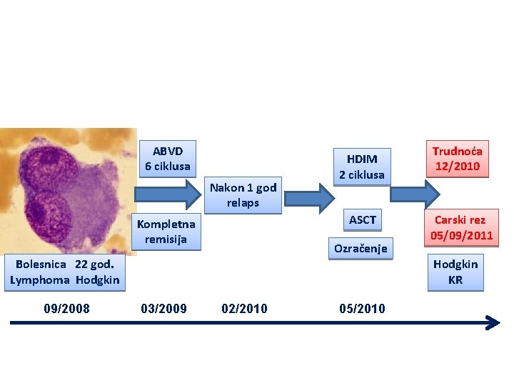 ABVD 6 ciklusa Nakon 1 god relaps HDIM 2 ciklusa ASCT Kompletna remisija Ozračenje