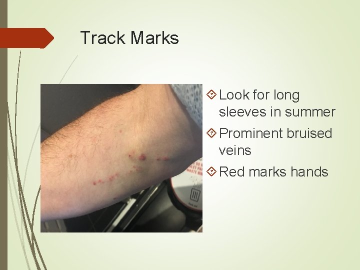 Track Marks Look for long sleeves in summer Prominent bruised veins Red marks hands