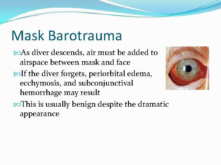 Mask Barotrauma As diver descends, air must be added to airspace between mask and