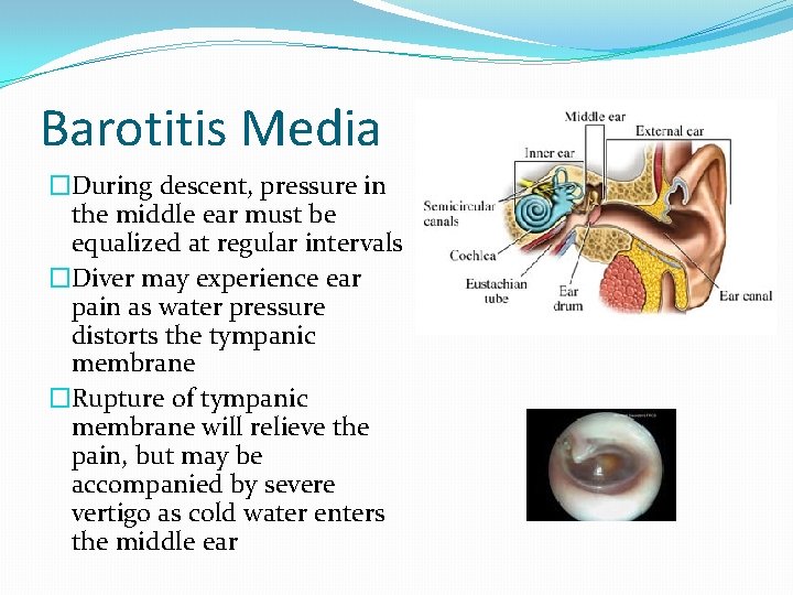 Barotitis Media �During descent, pressure in the middle ear must be equalized at regular