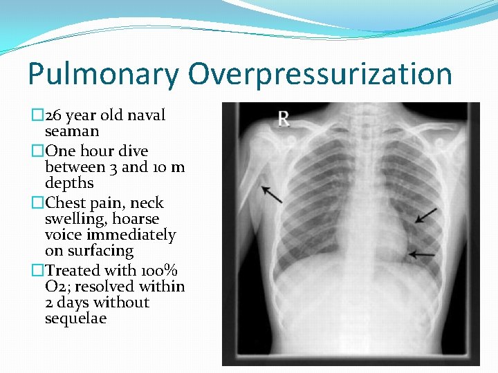 Pulmonary Overpressurization � 26 year old naval seaman �One hour dive between 3 and