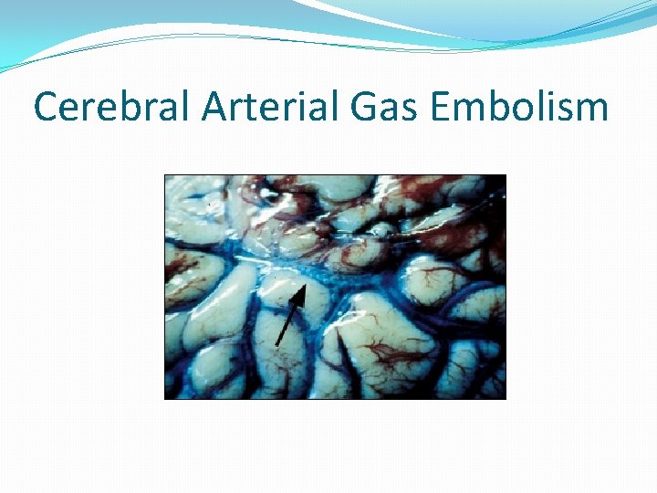 Cerebral Arterial Gas Embolism 