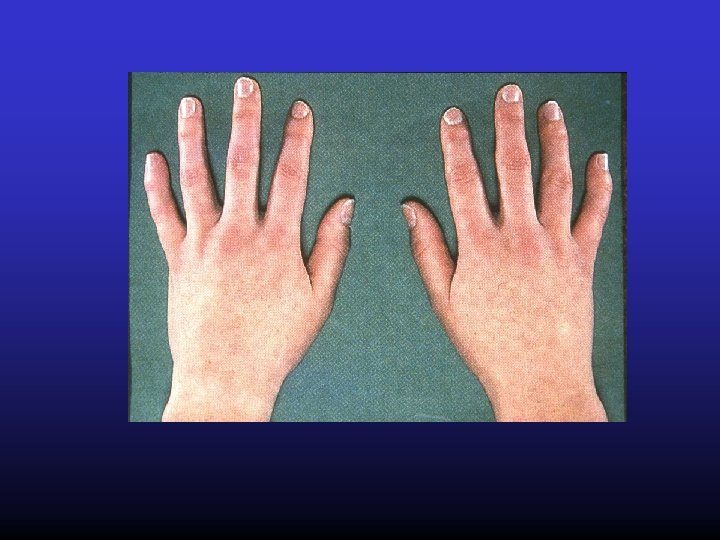 Korai rheumatoid arthritis 