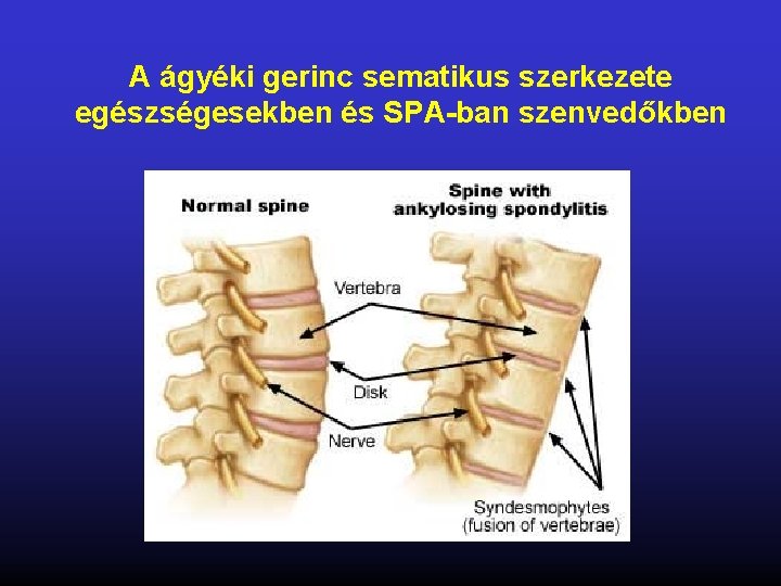 A ágyéki gerinc sematikus szerkezete egészségesekben és SPA-ban szenvedőkben 