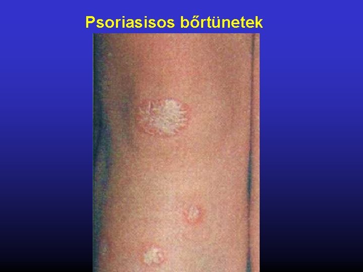 Psoriasisos bőrtünetek 