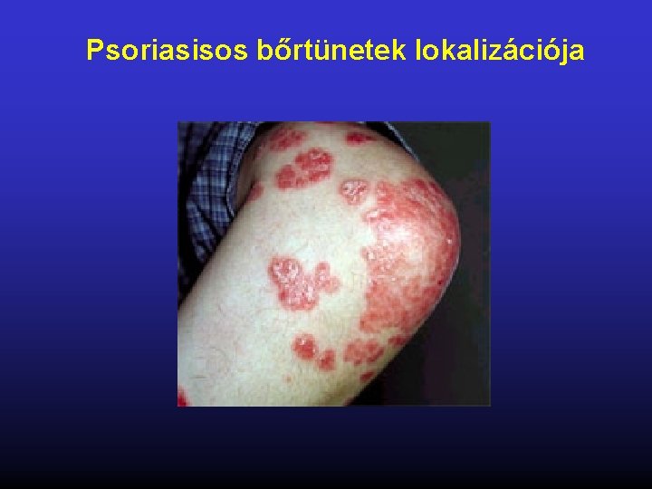 Psoriasisos bőrtünetek lokalizációja 