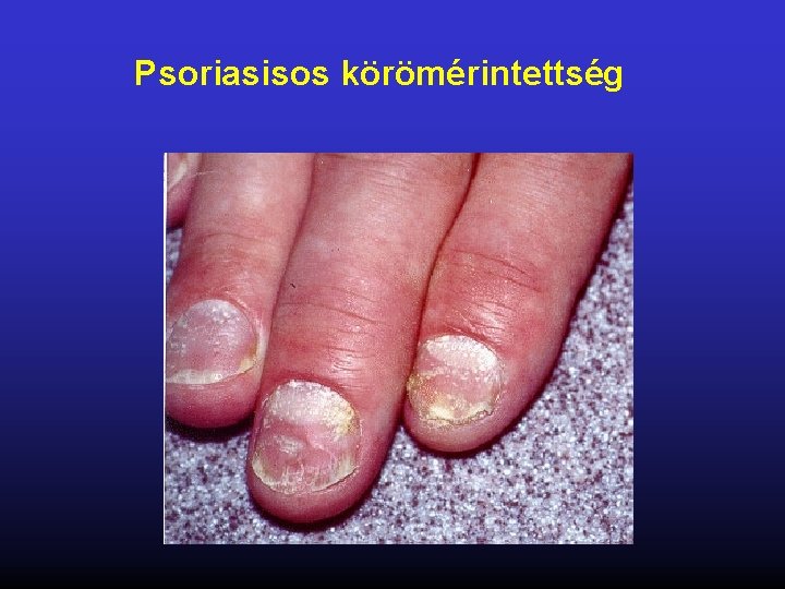 Psoriasisos körömérintettség 