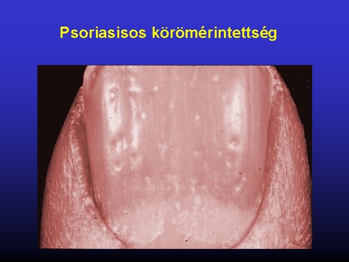 Psoriasisos körömérintettség 