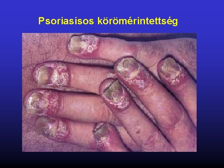 Psoriasisos körömérintettség 