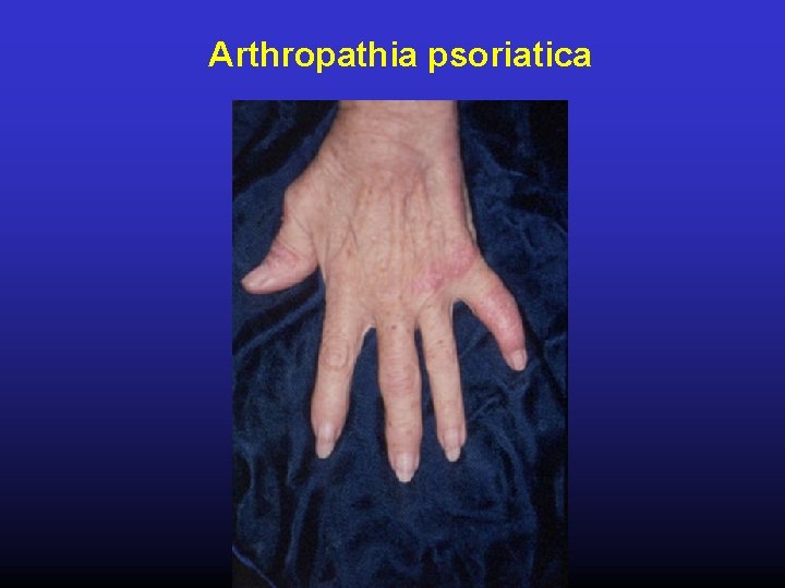 Arthropathia psoriatica 