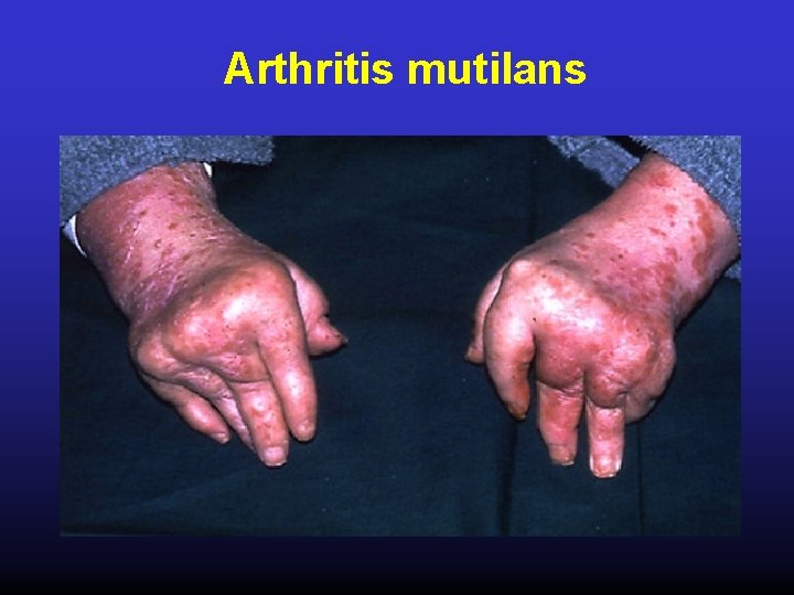 Arthritis mutilans 