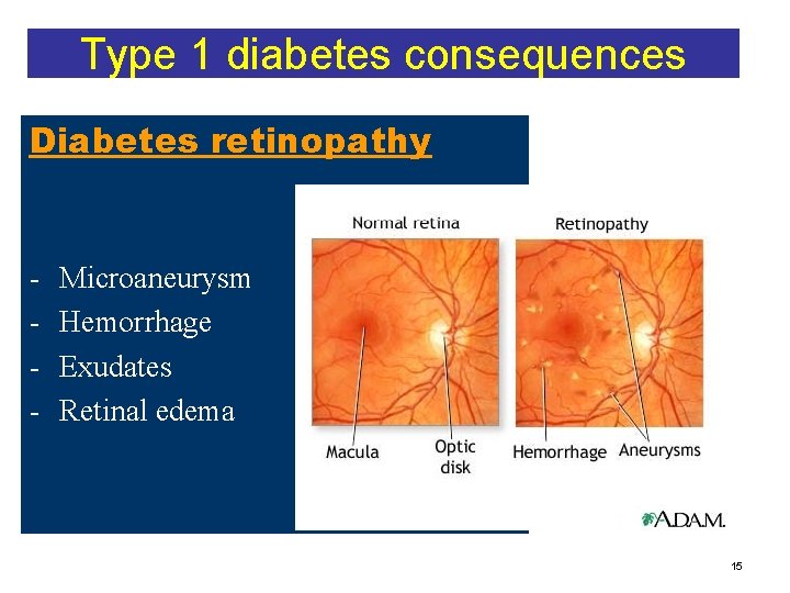 Type 1 diabetes consequences Diabetes retinopathy - Microaneurysm Hemorrhage Exudates Retinal edema 15 